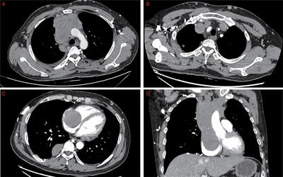 Case report: Complete resection of invasive thymoma invading the superior vena cava and right atrium under cardiopulmonary bypass support